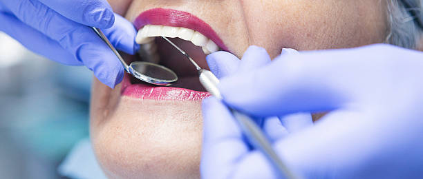 Best Emergency Dentist for Lost Fillings or Crowns in USA